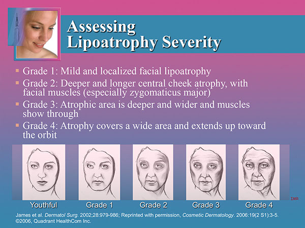 Lipoatrophy CME Presentation | Medical Meeting PPT Slides